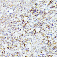 Immunohistochemistry of paraffin-embedded Human oophoroma using ACAT2 Polyclonal Antibody at dilution of 1:100 (40x lens) .