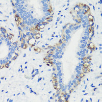 Immunohistochemistry of paraffin-embedded Human breast cancer using FLNA Polyclonal Antibody at dilution of 1:100 (40x lens) .