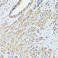 Immunohistochemistry of paraffin-embedded Human uterine cancer using FLNA Polyclonal Antibody at dilution of 1:100 (40x lens) .