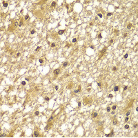 Immunohistochemistry of paraffin-embedded Human brain cancer using PIK3R3 Polyclonal Antibody at dilution of 1:100 (40x lens) .