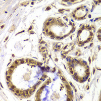 Immunohistochemistry of paraffin-embedded Human breast using HDAC4 Polyclonal Antibody at dilution of 1:100 (40x lens) .