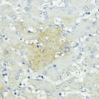 Immunohistochemistry of paraffin-embedded Human liver cancer using SOCS5 Polyclonal Antibody at dilution of 1:100 (40x lens) .