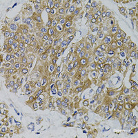 Immunohistochemistry of paraffin-embedded Human prostate cancer using ARHGEF11 Polyclonal Antibody