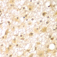 Immunohistochemistry of paraffin-embedded Human brain cancer using RUFY2 Polyclonal Antibody at dilution of 1:100 (40x lens) .