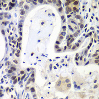 Immunohistochemistry of paraffin-embedded Human gastric cancer using LSM2 Polyclonal Antibody at dilution of 1:100 (40x lens) .