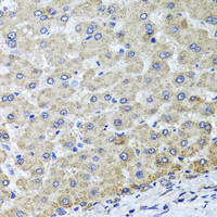 Immunohistochemistry of paraffin-embedded Human liver damage using OSGEPL1 Polyclonal Antibody at dilution of 1:100 (40x lens) .