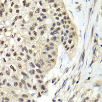 Immunohistochemistry of paraffin-embedded Human lung cancer using RFC5 Polyclonal Antibody at dilution of 1:100 (40x lens) .