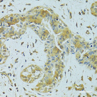 Immunohistochemistry of paraffin-embedded Human breast cancer using MTCH1 Polyclonal Antibody at dilution of 1:100 (40x lens) .