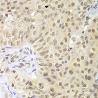 Immunohistochemistry of paraffin-embedded Human oophoroma using LHX4 Polyclonal Antibody at dilution of 1:100 (40x lens) .