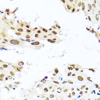 Immunohistochemistry of paraffin-embedded Human lung cancer using RAB3IP Polyclonal Antibody at dilution of 1:100 (40x lens) .