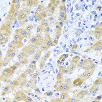 Immunohistochemistry of paraffin-embedded Human liver cancer using Gm13125 Polyclonal Antibody at dilution of 1:100 (40x lens) .