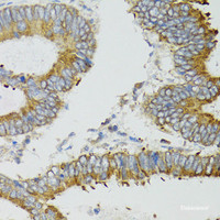 Immunohistochemistry of paraffin-embedded Human colon carcinoma using MT-ND5 Polyclonal Antibody at dilution of 1:100 (40x lens) .