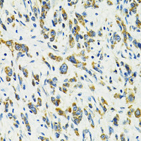 Immunohistochemistry of paraffin-embedded Human gastric cancer using SLC25A11 Polyclonal Antibody at dilution of 1:100 (40x lens) .