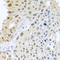 Immunohistochemistry of paraffin-embedded Human lung cancer using DNAL1 Polyclonal Antibody at dilution of 1:100 (40x lens) .