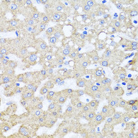 Immunohistochemistry of paraffin-embedded Human liver damage using ARL6 Polyclonal Antibody at dilution of 1:100 (40x lens) .