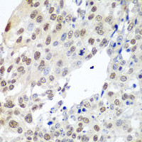 Immunohistochemistry of paraffin-embedded Human lung cancer using PTTG1 Polyclonal Antibody at dilution of 1:100 (40x lens) .