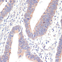 Immunohistochemistry of paraffin-embedded Human colon carcinoma using WNT5B Polyclonal Antibody at dilution of 1:100 (40x lens) .