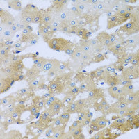 Immunohistochemistry of paraffin-embedded Human liver damage using AP1M2 Polyclonal Antibody at dilution of 1:100 (40x lens) .