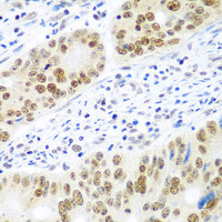 Immunohistochemistry of paraffin-embedded Human colon carcinoma using MDC1 Polyclonal Antibody at dilution of 1:100 (40x lens) .
