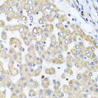 Immunohistochemistry of paraffin-embedded Human liver damage using RAB24 Polyclonal Antibody at dilution of 1:100 (40x lens) .