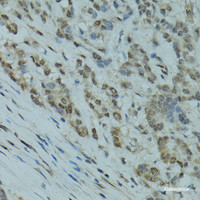 Immunohistochemistry of paraffin-embedded Human colon carcinoma using GABPA Polyclonal Antibody at dilution of 1:100 (40x lens) .