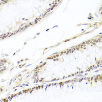 Immunohistochemistry of paraffin-embedded Human colon carcinoma using HIRA Polyclonal Antibody at dilution of 1:100 (40x lens) .