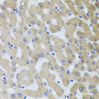 Immunohistochemistry of paraffin-embedded Human liver damage using UVRAG Polyclonal Antibody at dilution of 1:100 (40x lens) .