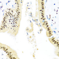 Immunohistochemistry of paraffin-embedded Human liver damage using ZBTB17 Polyclonal Antibody at dilution of 1:100 (40x lens) .