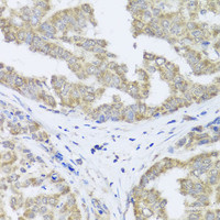 Immunohistochemistry of paraffin-embedded Human liver cancer using TIMM10B Polyclonal Antibody at dilution of 1:100 (40x lens) .