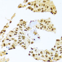 Immunohistochemistry of paraffin-embedded Human lung cancer using SMEK1 Polyclonal Antibody at dilution of 1:100 (40x lens) .