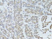 Immunohistochemistry of paraffin-embedded Human colon carcinoma using TEFM Polyclonal Antibody at dilution of 1:100 (40x lens) .