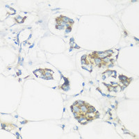 Immunohistochemistry of paraffin-embedded Human mammary cancer using NMT1 Polyclonal Antibody at dilution of 1:100 (40x lens) .
