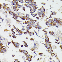 Immunohistochemistry of paraffin-embedded Human lung cancer using SUCLG2 Polyclonal Antibody at dilution of 1:100 (40x lens) .