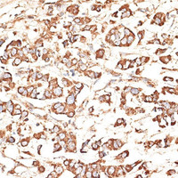 Immunohistochemistry of paraffin-embedded Human mammary cancer using KIR3DS1 Polyclonal Antibody at dilution of 1:100 (40x lens) .