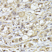 Immunohistochemistry of paraffin-embedded Human liver cancer using PSMB3 Polyclonal Antibody at dilution of 1:100 (40x lens) .