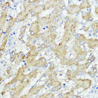 Immunohistochemistry of paraffin-embedded Human liver cancer using SOCS6 Polyclonal Antibody at dilution of 1:100 (40x lens) .