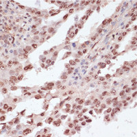 Immunohistochemistry of paraffin-embedded Human lung cancer using Phospho-ATF2 (T71) Polyclonal Antibody at dilution of 1:100 (40x lens) .