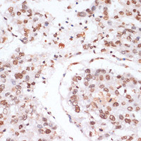 Immunohistochemistry of paraffin-embedded Human liver cancer using Phospho-Stat3 (Y705) Polyclonal Antibody at dilution of 1:100 (40x lens) .