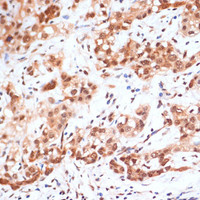 Immunohistochemistry of paraffin-embedded Human liver cancer using Phospho-STAT1 (S727) Polyclonal Antibody at dilution of 1:100 (40x lens) .