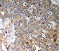 Immunohistochemistry of paraffin-embedded Human breast carcinoma using Phospho-GSK3B（Y216）/GSK3A（Y279）Polyclonal Antibody