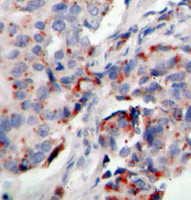 Immunohistochemistry of paraffin-embedded Human breast carcinoma tissue, using Phospho-JAK2 (Y221) Polyclonal Antibody