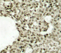 Immunohistochemistry of paraffin-embedded Human breast carcinoma tissue, using Phospho-STAT1 (S727) Polyclonal Antibody