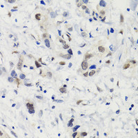 Immunohistochemistry of paraffin-embedded Human gastric cancer using Phospho-Stat3 (S727) Polyclonal Antibody at dilution of 1:100 (40x lens) .