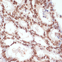 Immunohistochemistry of paraffin-embedded Human colon carcinoma using Phospho-β-catenin (S33/S37/T41) Polyclonal Antibody at dilution of 1:100 (40x lens) .