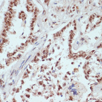 Immunohistochemistry of paraffin-embedded Human lung cancer using Phospho-β-catenin (S33/S37/T41) Polyclonal Antibody at dilution of 1:100 (40x lens) .