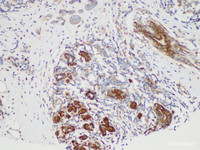 Immunohistochemistry of paraffin-embedded Human breast cancer using S100B Polycloanl Antibody at dilution of 1:50