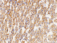 Immunohistochemistry of paraffin-embedded Human liver cancer using GPNMB Polycloanl Antibody at dilution of 1:200