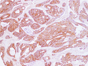 Immunohistochemistry of paraffin-embedded Human carcinoma of Colon using POSTN Polyclonal Antibody at dilution of 1:100 (100×)