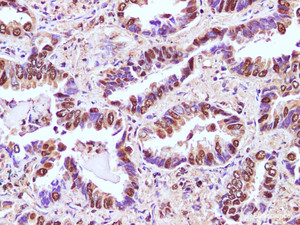 Immunohistochemistry of paraffin-embedded Human lung cancer using RBM3 Polyclonal Antibody at dilution of 1:100