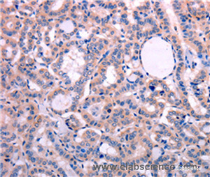 Immunohistochemistry of paraffin-embedded Human thyroid cancer tissue using LEP Polyclonal Antibody at dilution 1:30